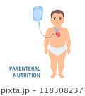 Child receiving parenteral nutrition through a central intravenous access 118308237
