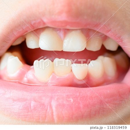 歯が抜ける 118319459