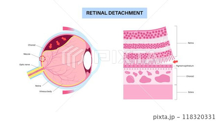 Retinal detachment eye disease 118320331
