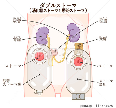 人工肛門、ダブルストーマのイラスト、illustrationのイラスト