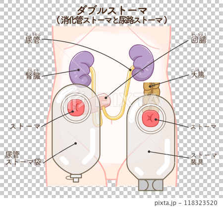 人工肛門、ダブルストーマのイラスト、illustrationのイラスト