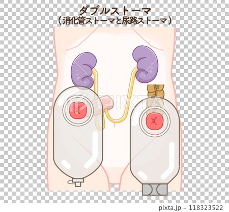 人工肛門、ダブルストーマのイラスト、illustration 118323522