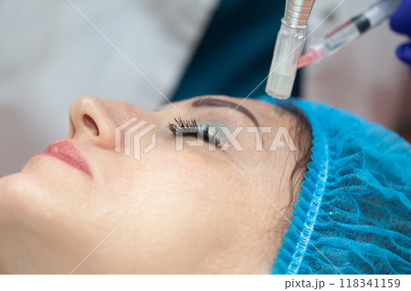 Application of an anti-aging facial rejuvenation cocktail using micro needles. Dermatology concept. Aesthetic medicine concept. Application of an anti-aging facial rejuvenation cocktail using micro needles. Dermatology concept. Aesthetic medicine concept. 118341159