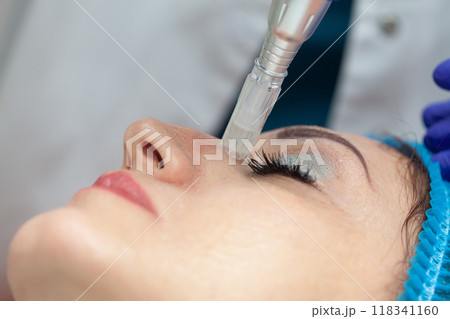 Application of an anti-aging facial rejuvenation cocktail using micro needles. Dermatology concept. Aesthetic medicine concept. Application of an anti-aging facial rejuvenation cocktail using micro needles. Dermatology concept. Aesthetic medicine concept. 118341160
