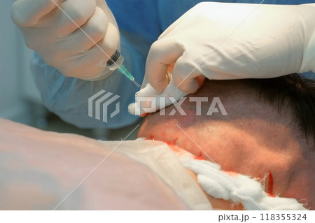 Surgeon wiping head of man with napkin preparing to hair transplant surgery. 118355324