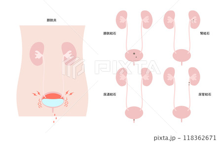 シンプルな泌尿器科疾患のイラスト シンプルな泌尿器科疾患のイラスト 118362671