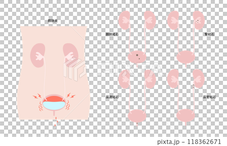 シンプルな泌尿器科疾患のイラスト シンプルな泌尿器科疾患のイラスト 118362671
