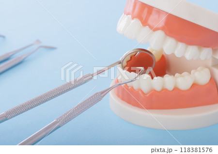 歯の模型と歯科治療のイメージ 118381576