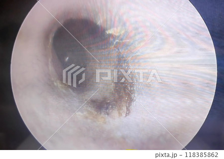 ear wax build up symptoms 118385862