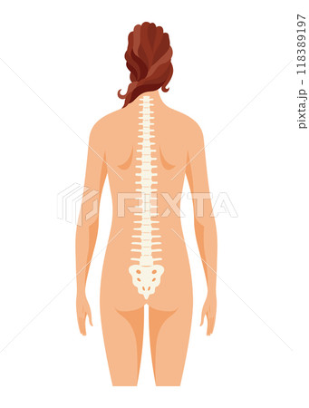 Scoliosis affecting individuals of all ages. Schematic poster of a woman with scoliosis 118389197