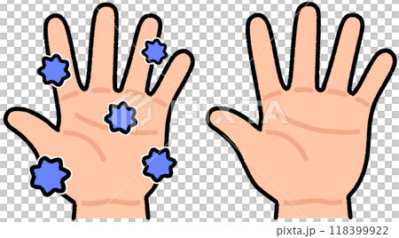 Bacterial hands and clean hands 118399922