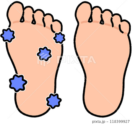 菌だらけの足ときれいな足 菌だらけの足ときれいな足 118399927