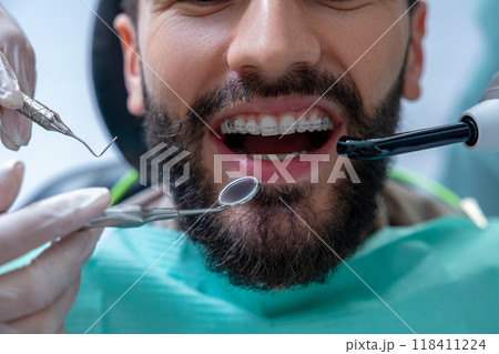 Orthodontic specialist using professional instruments to inspect teeth for caries and provide care Orthodontic specialist using professional instruments to inspect teeth for caries and provide care 118411224