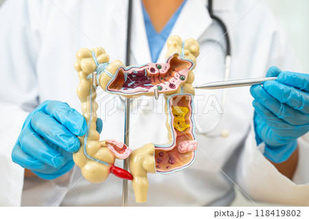 Ulcerative Colitis. Intestine, appendix and digestive system, doctor holding anatomy model for study diagnosis and treatment in hospital. Ulcerative Colitis. Intestine, appendix and digestive system, doctor holding anatomy model for study diagnosis and treatment in hospital. 118419802