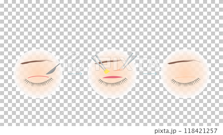 Double eyelid surgery illustration Double eyelid surgery illustration 118421257