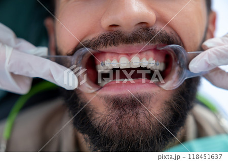 Man patient with with open mouth in dental clinic treating his teeth Man patient with with open mouth in dental clinic treating his teeth 118451637