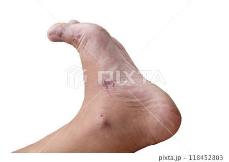 Injured foot , Lesion with hematoma or contusion 118452803