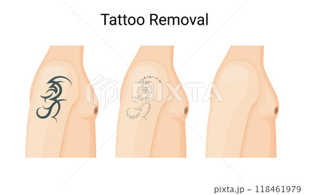 Laser Tattoo Removal Procedure for Clear Skin 118461979