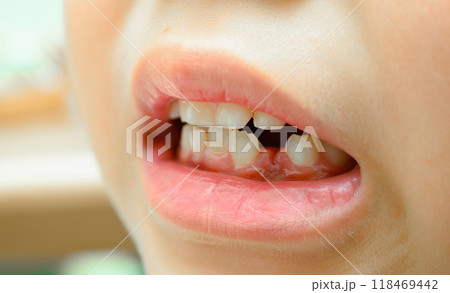 歯が抜ける 歯が抜ける 118469442