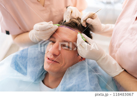 Close-up of unrecognizable trichologist surgeons carry out hair transplant surgery in operating room to patient with hairloss problem. Surgical technique that moves hair follicles from part of head. 118483067