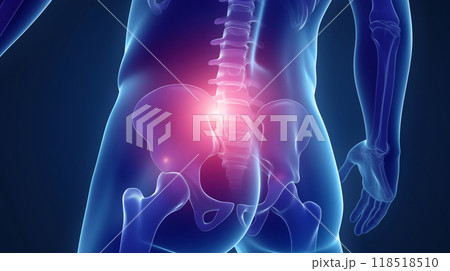 腰痛の視覚表現: ルンバー領域での痛みと不快感を具現化したイメージ. 118518510
