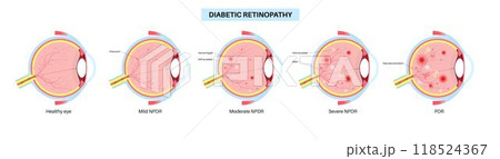 Diabetes related retinopathy 118524367