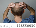 Close up of baldness  men's head with thin hair on his top and back head. 118550930