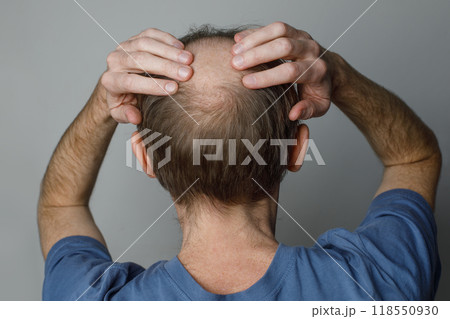 Close up of baldness men's head with thin hair on his top and back head. Close up of baldness men's head with thin hair on his top and back head. 118550930
