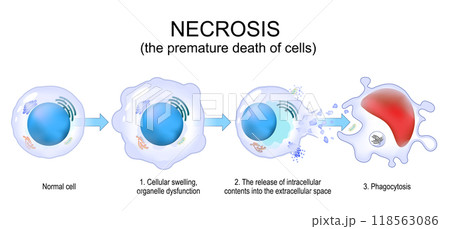 Necrosis. Uncontrolled cell death. 118563086