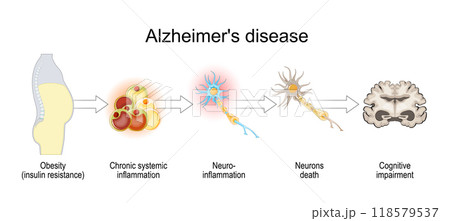 Alzheimers disease and insulin resistance. 118579537