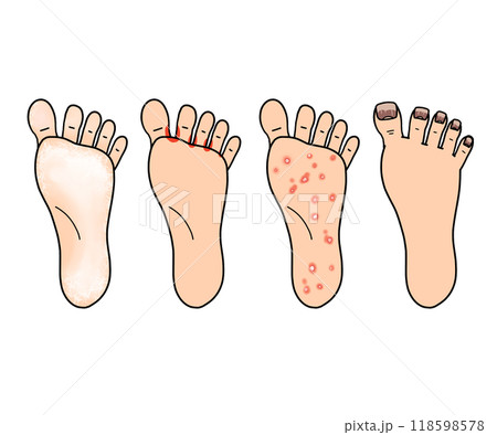 白癬(水虫)の種類(文字なし) 白癬(水虫)の種類(文字なし) 118598578