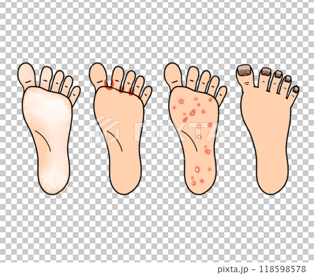 白癬(水虫)の種類(文字なし) 白癬(水虫)の種類(文字なし) 118598578