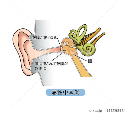 急性中耳炎（文字あり） 118598584