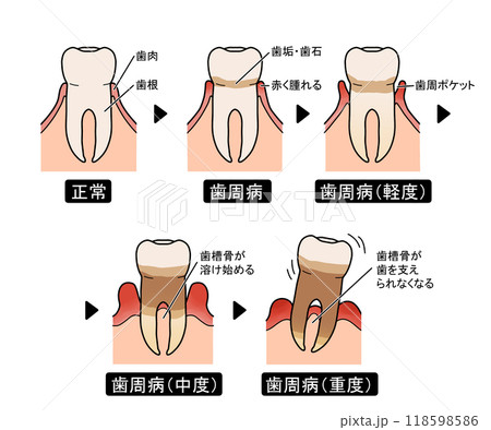 歯周病の進行(文字あり) 歯周病の進行(文字あり) 118598586