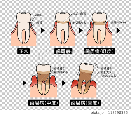 歯周病の進行(文字あり) 歯周病の進行(文字あり) 118598586