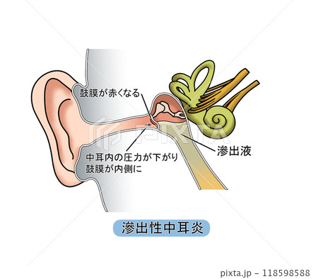 滲出性中耳炎（文字あり） 118598588