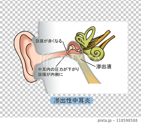 滲出性中耳炎（文字あり） 118598588