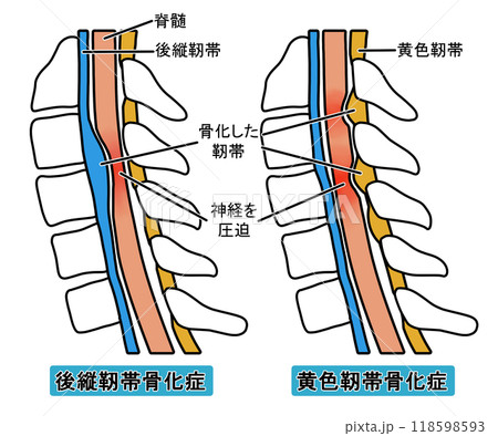 後縦靭帯骨化症と黄色靭帯骨化症（文字あり） 118598593