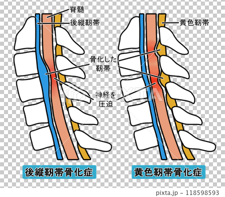 後縱韌帶骨化和黃韌帶骨化（附文字） 118598593