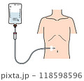 腹部への皮下持続点滴 118598596