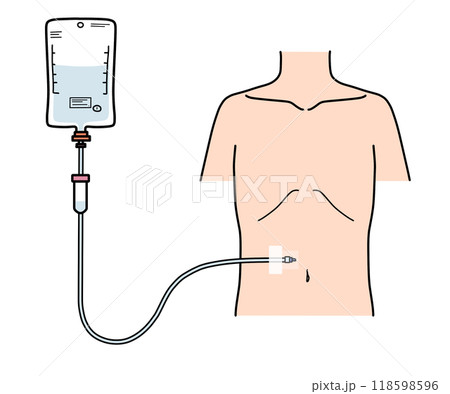 腹部への皮下持続点滴 118598596