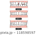 歯列矯正が必要な歯並びPart1 118598597