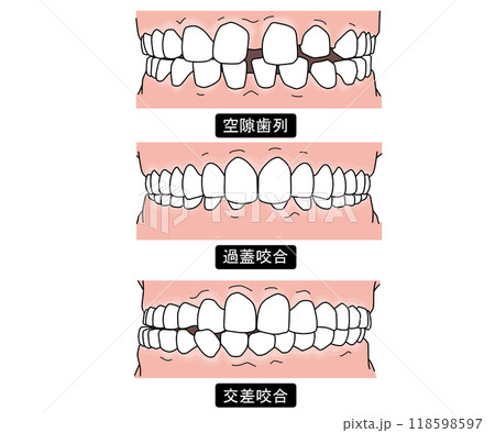 歯列矯正が必要な歯並びPart1 118598597