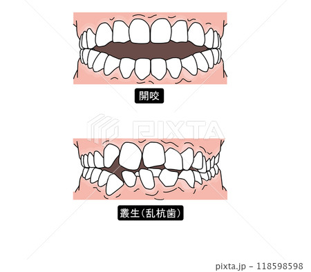 歯列矯正が必要な歯並びPart2 歯列矯正が必要な歯並びPart2 118598598