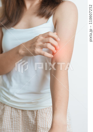 woman itching and scratching itchy arm. Sensitive Skin Allergic reaction to insect bite, food, drug dermatitis. Dermatology, Leprosy day, Systemic lupus erythematosus, Allergy symptoms and rash Eczema 118607252
