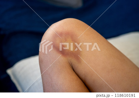 膝の内側にアザができた10歳の男の子 膝の内側にアザができた10歳の男の子 118610191