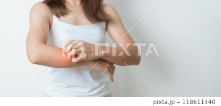 woman itching and scratching itchy arm. Sensitive Skin Allergic reaction to insect bite, food, drug dermatitis. Dermatology, Leprosy day, Systemic lupus erythematosus, Allergy symptoms and rash Eczema woman itching and scratching itchy arm. Sensitive Skin Allergic reaction to insect bite, food, drug dermatitis. Dermatology, Leprosy day, Systemic lupus erythematosus, Allergy symptoms and rash Eczema 118611340