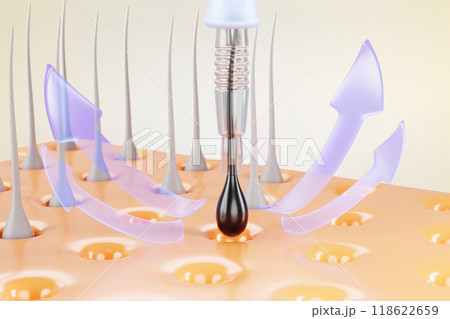 3d hair transplant procedure banner. Follicular unit extraction. Scalp with follicle, graft removal punch and infographic arrows. Hair restoration surgery, baldness treatment concept. 3D illustration 3d hair transplant procedure banner. Follicular unit extraction. Scalp with follicle, graft removal punch and infographic arrows. Hair restoration surgery, baldness treatment concept. 3D illustration 118622659