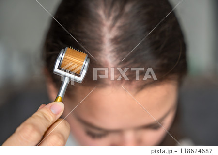 Close up view of young woman using microneedle derma roller on head for stimulating new hair growth in home. Treatment for the healthy scalp. Close up view of young woman using microneedle derma roller on head for stimulating new hair growth in home. Treatment for the healthy scalp. 118624687
