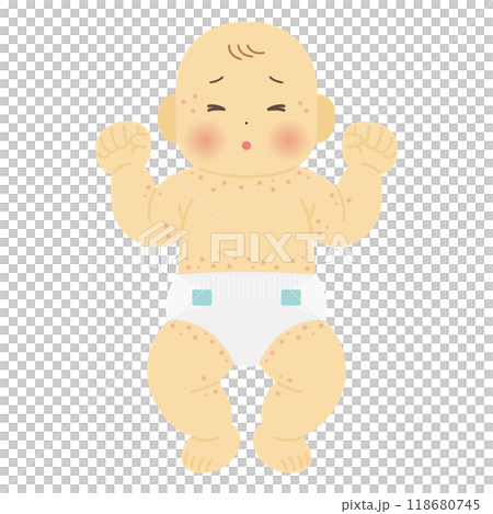 Illustration of a baby with eczema - Stock Illustration [118680745] - PIXTA